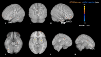 Credit: Neurobiology of Aging (2024). DOI: 10.1016/j.neurobiolaging.2024.10.006
