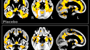 Vitacog trial - B vits reduce brain shrinkage - Credit Smith et al 2010.png
